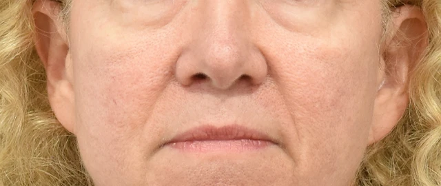 Eyelid Surgery Patient 28 Set 1 Before