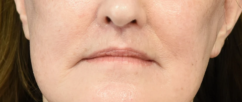 Lip Lift Patient 15 Set 1 After