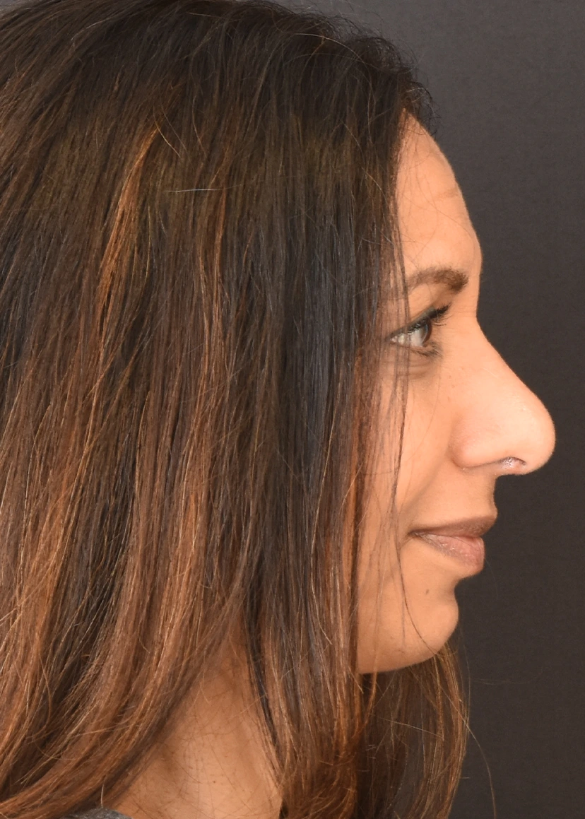 Rhinoplasty Patient 10 Set 3 After